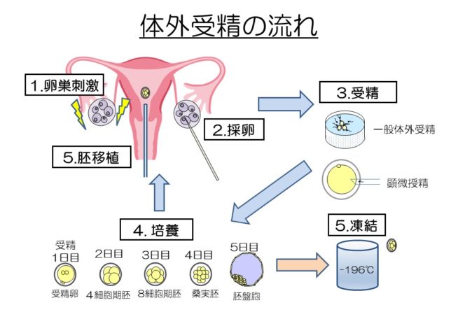 体外受精の流れ